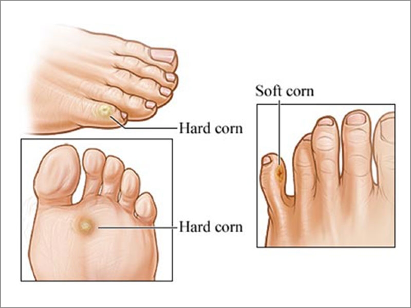 healing corn on foot