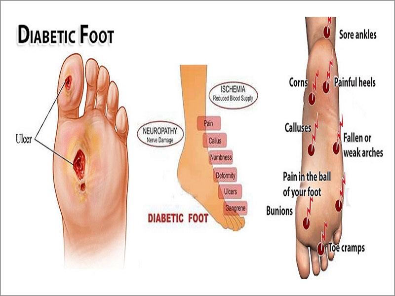 Heel Spurs: Symptoms, Causes, and Prevention